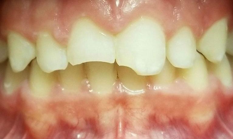 Bonding-on-2-Front-Teeth-After-an-Accident-Before-Image