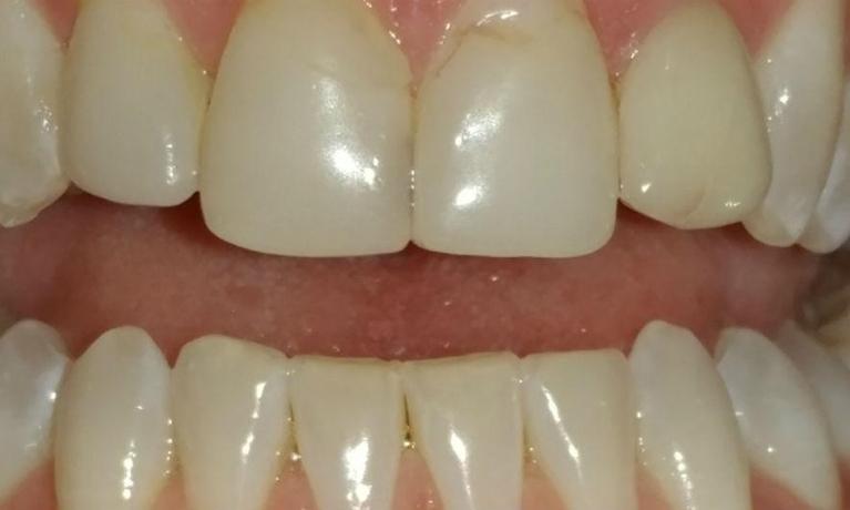 Replaced-4-Front-Veneers-Before-Image