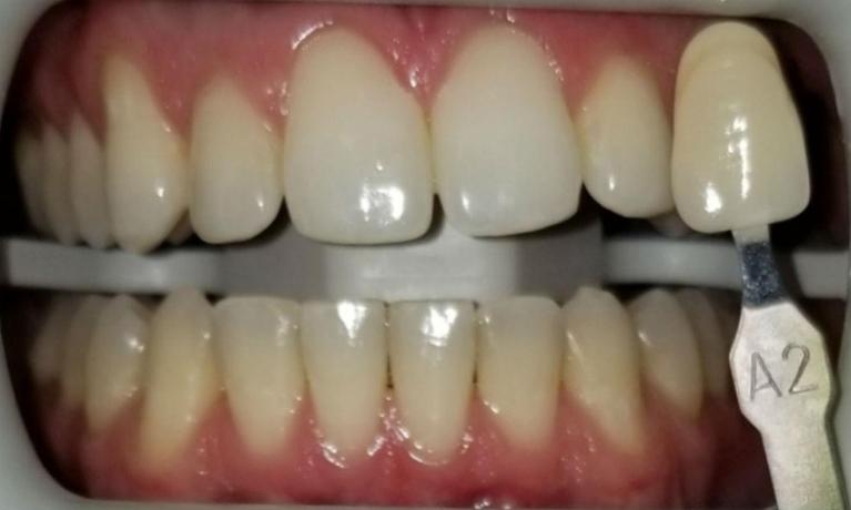 In-Office-Teeth-Whitening-Before-Image